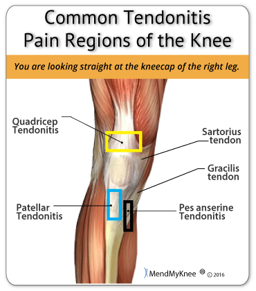 Prepatellar Bursitis: Causes Diagnosis Treatment