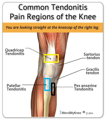 common tendonitis regions of the knee
