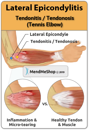 Tennis Elbow Tendinosis