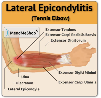 tennis elbow anatomical image
