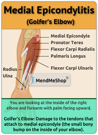 Tendinosis Golfers Elbow