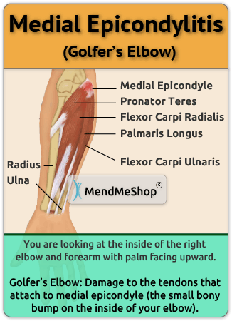 golfer elbow anatomical image