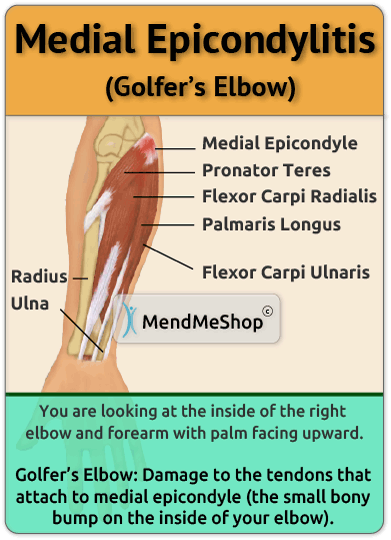 golfers elbow tendon pain