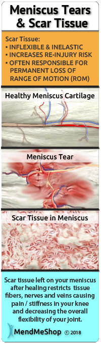 Scar tissue builds in your knee as tears heal