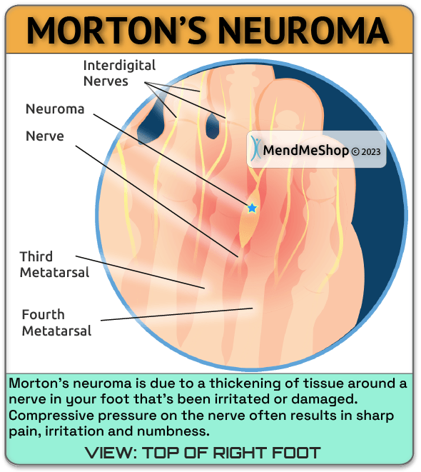 mortons neuroma ball of foot pain