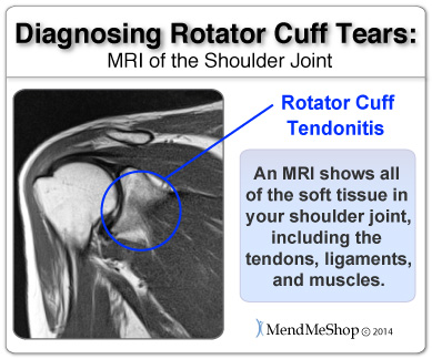 supraspinatus tendovaginitis shoulder mri