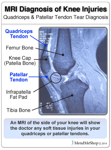 MRI to see the patellar tendon in the knee