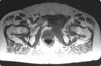 MRI of pelvic region including iliopsoas