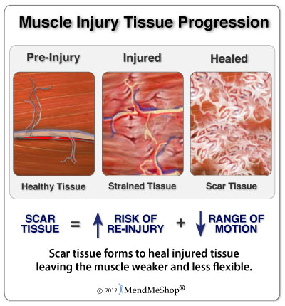 tendon muscle ligament scar tissue