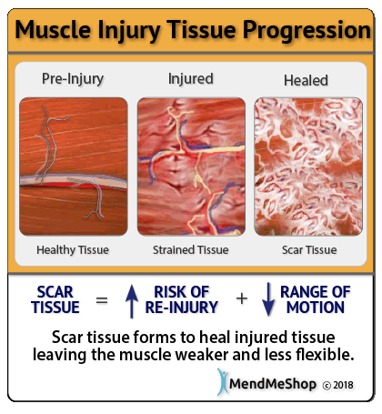 soft tissue injury hip close up view