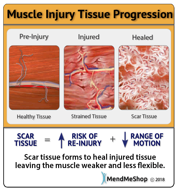 Hamstring Muscle tears heal with scar tissue, restricting movement and causing pain and stiffness.