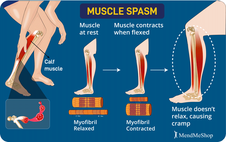 muscle spasm caused by contracting myofibril