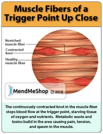 Trigger Point Muscle Fibers