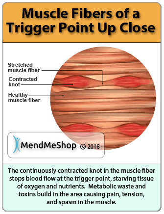 Myofascial pain trigger points cause knots in the muscle fibers resulting in tight muscle.