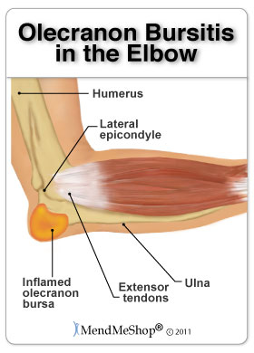 Elbow pain can be caused by bursa pain, or golfers elbow.