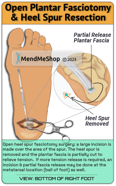 open plantar fascia release surgery