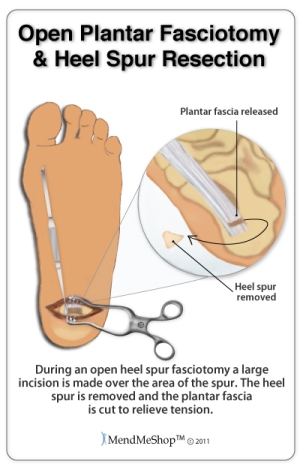 Open heel-spur fasciotomy surgery
