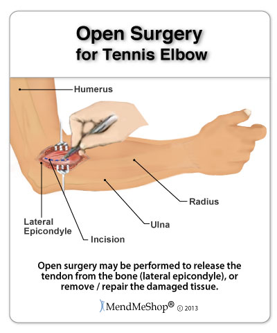 Tennis Elbow open elbow surgery - 90% of people suffering from Tennis Elbow can heal through conservative treatment methods.