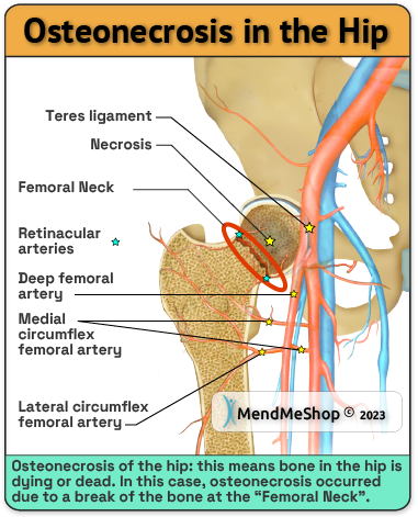 https://tshellzwrap.com/_img_global/osteonecrosis-of-hip-due-to-femoral-neck-break.png