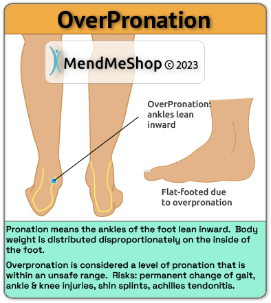 Chronic Achilles tendinitis may be caused by over-pronation of the foot or flat feet.