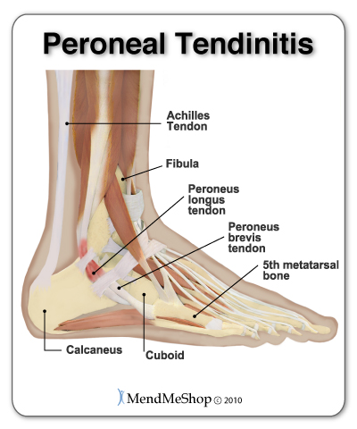 peroneal tendonitis ankle
