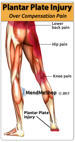 Plantar Plate Injury Overcompensation Pain Limp