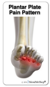 Plantar Plate Tear Pain Pattern