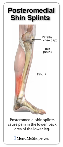 Posteromedial Shin Splint or Medial Tibial Stress Syndrome (MTSS) pain areas