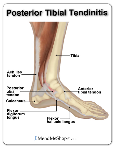 Posterior tibial tendonitis