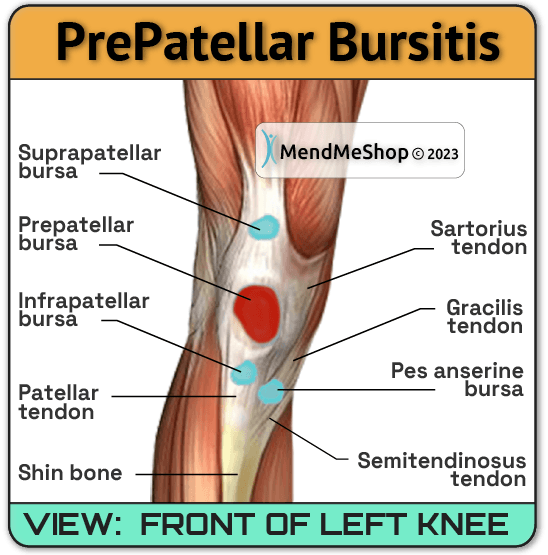 Pain below the knee cap is a symptom of prepatellar bursitis