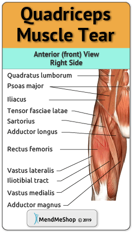quadriceps muscle tear