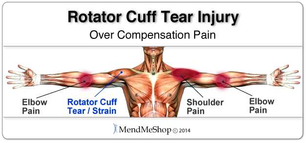 Over compensation pain setback tendon tear