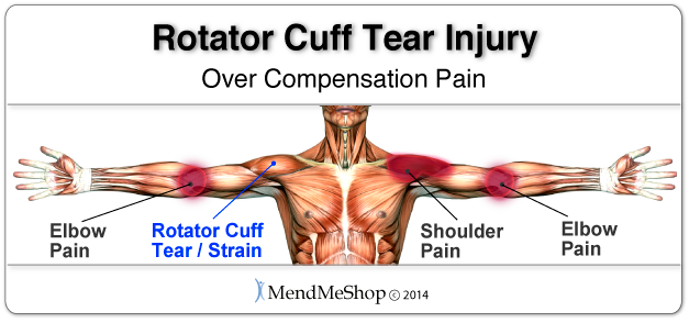 Pain supraspinatus deals