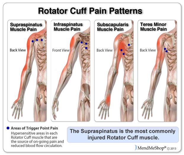 Rotator cuff pain can translate into trigger point pain - which are hypersensitive areas in the muscle that are the source of on-going pain.