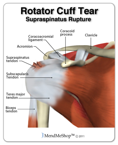shoulder pain can be caused by a damaged rotator cuff