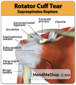 Chronic degeneration or a acute trauma can tear a rotator cuff tendon, usually the supraspinatus tendon.