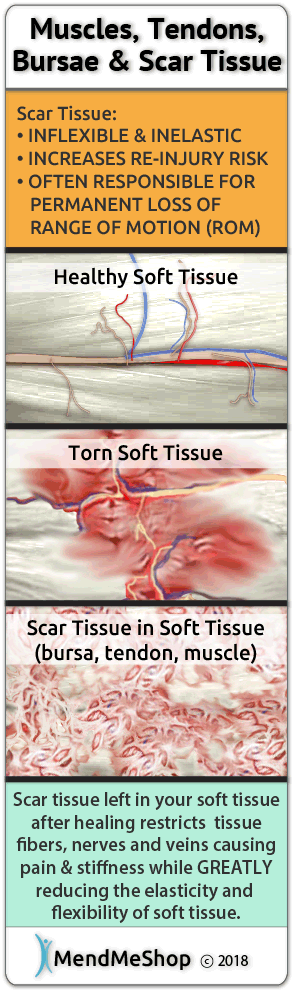 Scar tissue grows to protect your bursa injury after surgery.