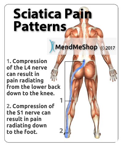 sciatica pain s1 nerve compression
