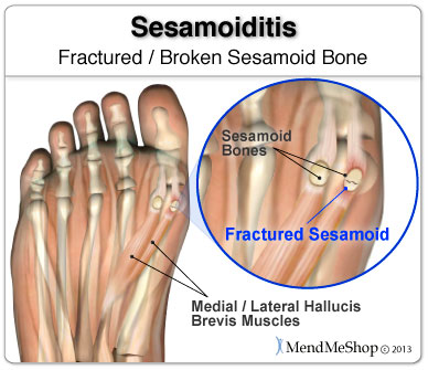 Sesamoiditis can sometimes involve a break or fracture to your sesamoid bone