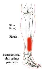 Posteromedial Shin Splint pain areas