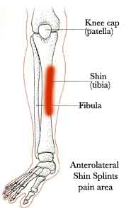Anterolateral Shin Splint pain areas