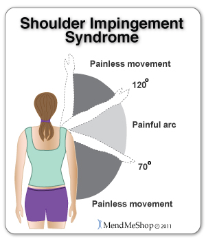 shoulder impingement arc pain diagnosis