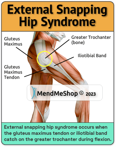external snapping hip syndrome