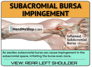subacromial bursitis shoulder impingement painful