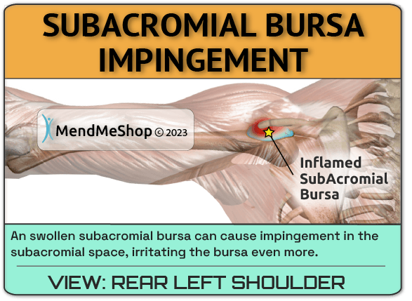 Subacromial and subdeltoid bursae impingement in the shoulder