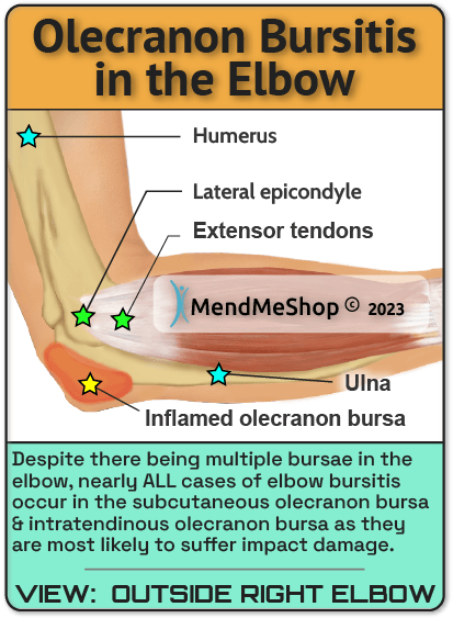 olecranon bursitis is the most common elbow bursitis 