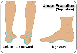 Under Pronation of the Foot (Supination)