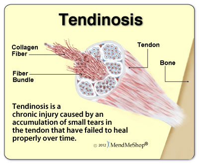 Quadriceps Tendinosis  can cause pain at the front of the knee 