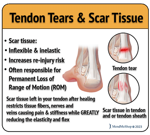 back of heel scar tissue