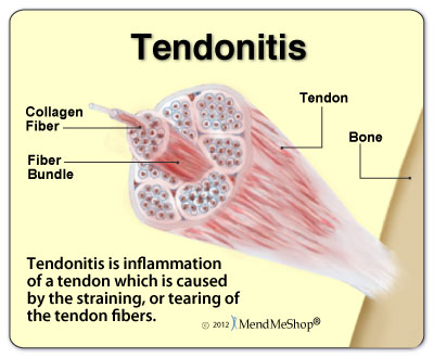 Tendonitis is inflammation of a tendon from micro-tearing of the tissue
